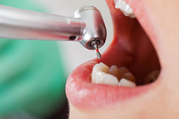 Best Urgent Care for Lost Fillings or Crowns in North Canton, OH